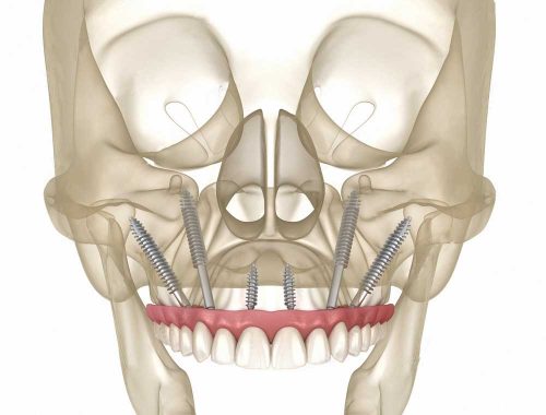 Fortgeschrittener Knochenabbau im Oberkiefer: Wenn der Knochen im Oberkiefer aufgrund von Zahnverlust oder anderen Gründen stark abgebaut ist, kann es schwierig sein, herkömmliche Implantate zu platzieren. Zygoma-Implantate können in diesem Fall eine bessere Option sein, da sie im Jochbein verankert werden, das in der Regel stärker und widerstandsfähiger ist als der Kieferknochen. Nicht ausreichende Knochenhöhe im Oberkiefer: In einigen Fällen kann die Knochenhöhe im Oberkiefer nicht ausreichend sein, um herkömmliche Implantate sicher zu verankern. Zygoma-Implantate können in diesem Fall eine geeignete Option sein, da sie länger sind als herkömmliche Implantate und im Jochbein verankert werden können. Patienten mit fortgeschrittener Parodontitis: Patienten, die an fortgeschrittener Parodontitis leiden, können oft nicht für herkömmliche Implantate in Frage kommen, da die Erkrankung den Kieferknochen schädigt und destabilisiert. Zygoma-Implantate können in diesem Fall eine bessere Option sein, da sie im Jochbein verankert werden und daher eine stabilere Basis bieten. Patienten mit einer angeborenen Kieferfehlstellung: Patienten mit einer angeborenen Kieferfehlstellung können oft Schwierigkeiten haben, herkömmliche Implantate im Oberkiefer zu tragen. Zygoma-Implantate können in diesem Fall eine geeignete Option sein, da sie unabhängig von der Position des Kiefers im Jochbein verankert werden können.